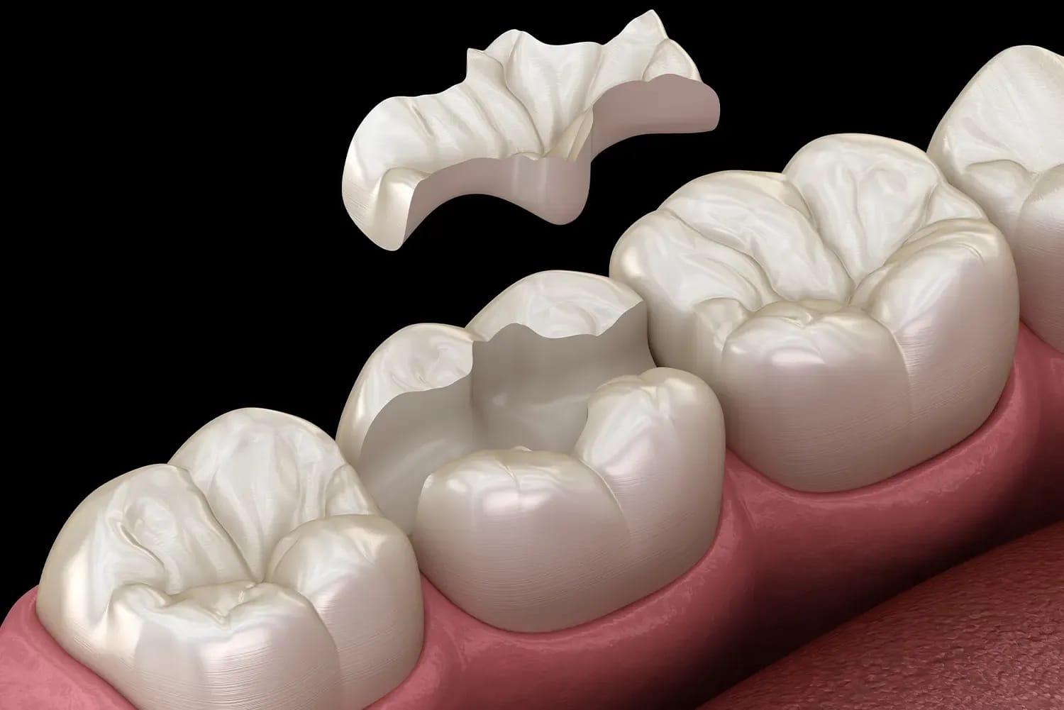 3D illustration of a custom ceramic dental onlay being placed onto a prepared molar tooth.