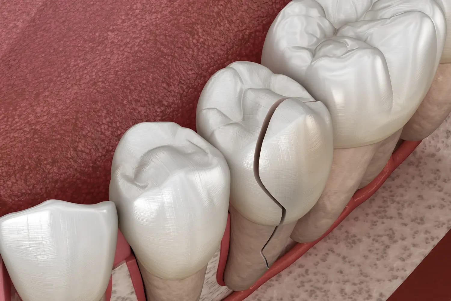 Emergency dentist treatment for chipped tooth at Cleopatra Dental in Riverside and Yorba Linda, CA