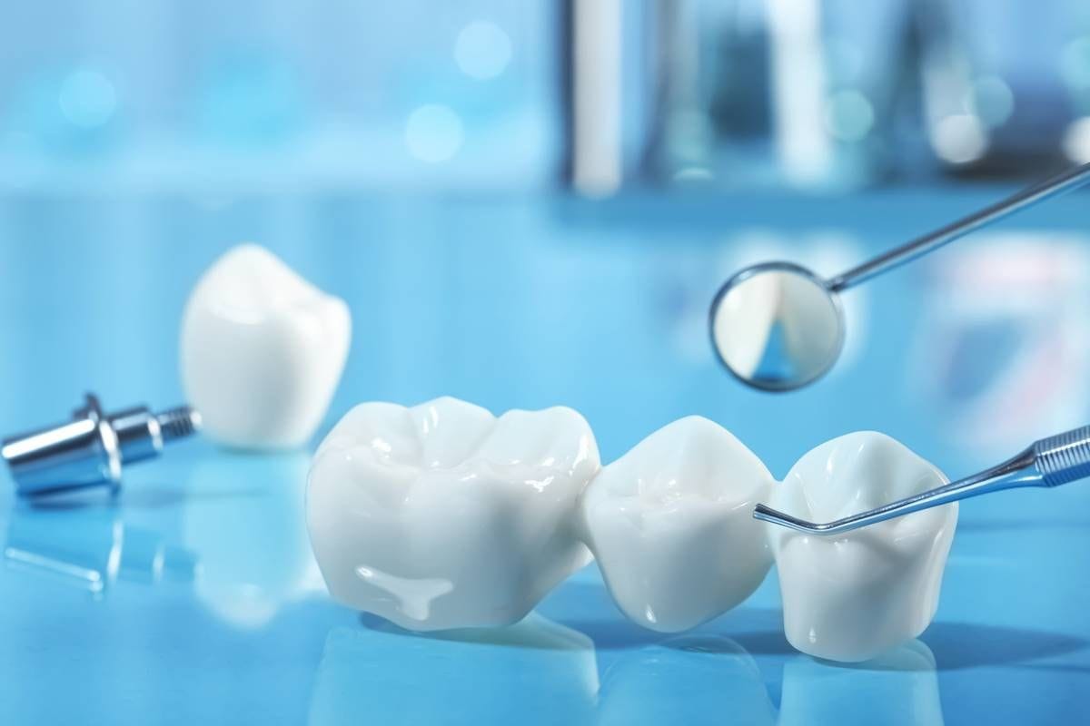 Dental bridge lifespan and care at Cleopatra Dental